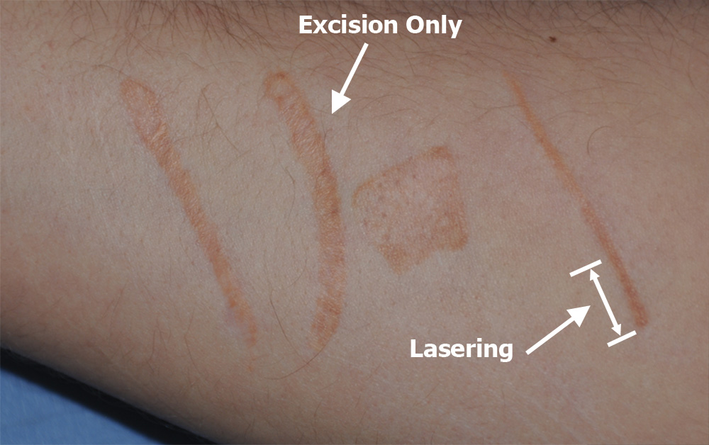 Scar Revision Before & After Photo