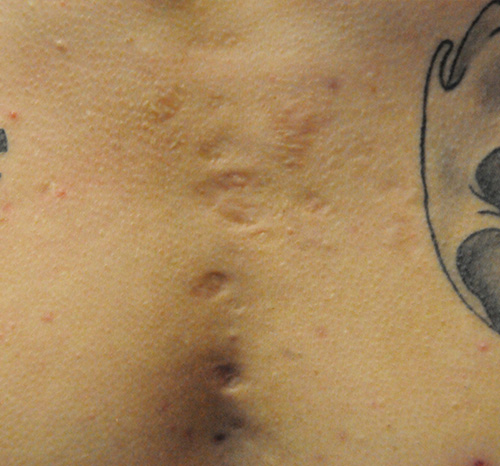 Scar Revision Before & After Photo