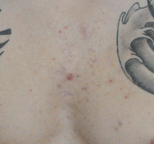 Scar Revision Before & After Photo