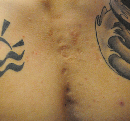 Scar Revision Before & After Photo