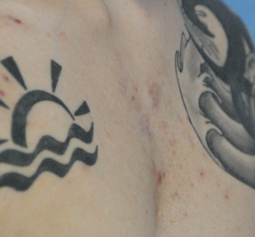 Scar Revision Before & After Photo