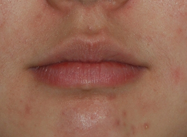 Facial Fillers Before & After Photo