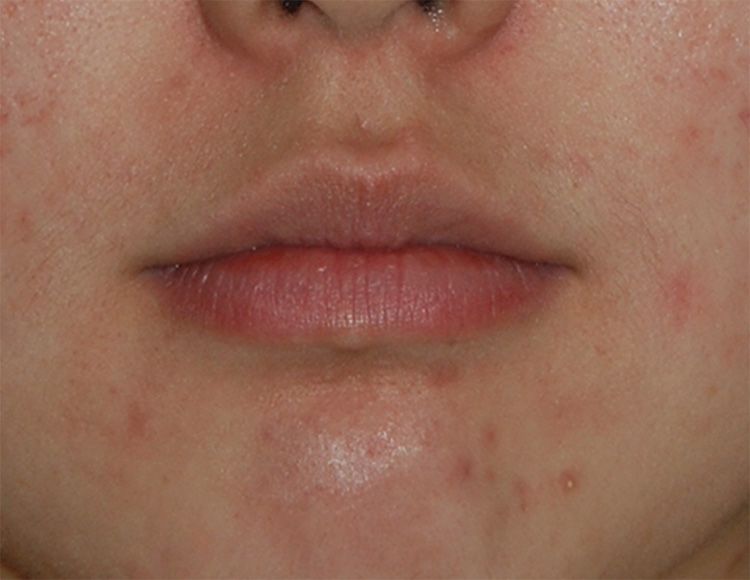 Facial Fillers Before & After Photo