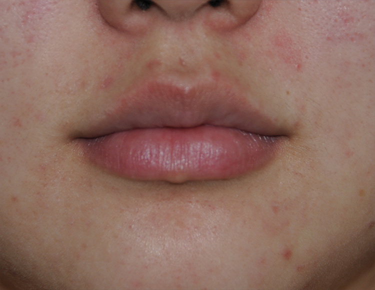 Facial Fillers Before & After Photo