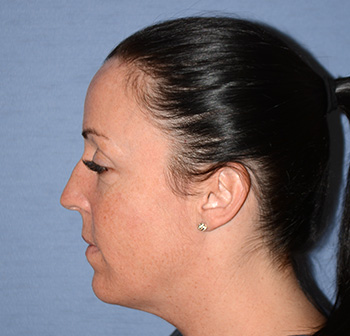 Facial Fillers Before & After Photo