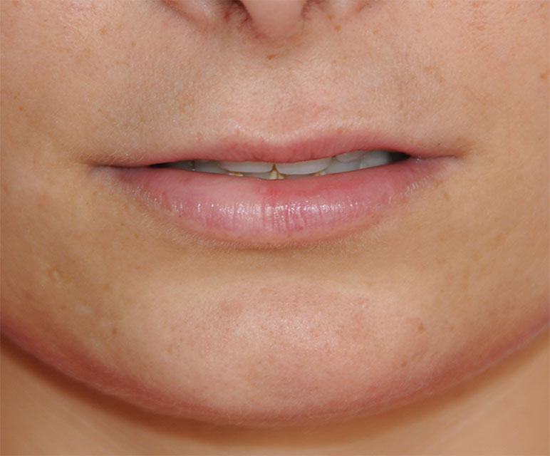 Facial Fillers Before & After Photo