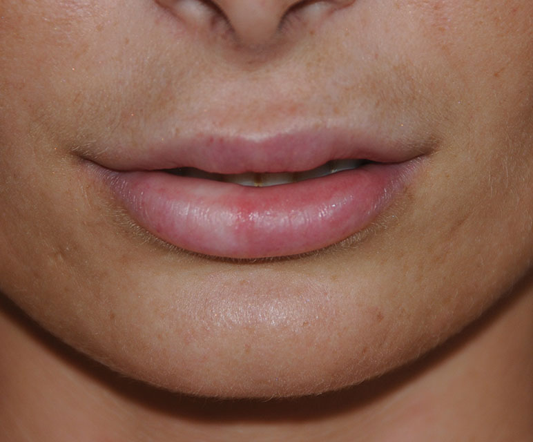 Facial Fillers Before & After Photo