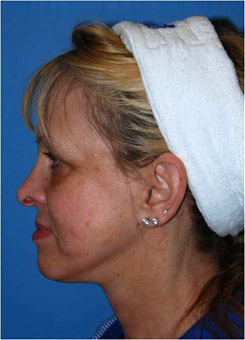 Facial Fillers Before & After Photo