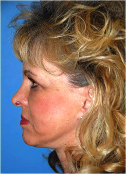 Facial Fillers Before & After Photo