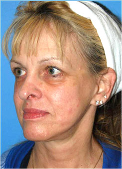 Facial Fillers Before & After Photo