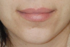 Facial Fillers Before & After Photo