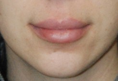 Facial Fillers Before & After Photo