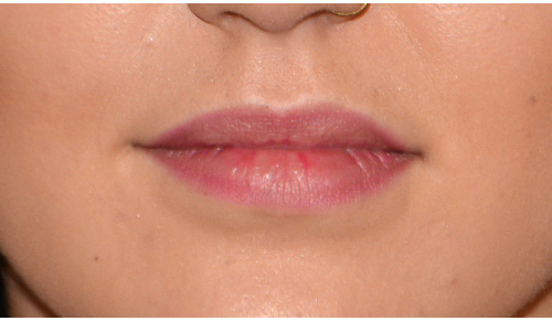 Facial Fillers Before & After Photo