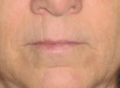 Facial Fillers Before & After Photo