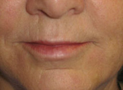 Facial Fillers Before & After Photo