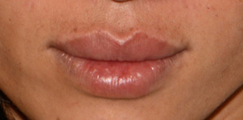 Facial Fillers Before & After Photo