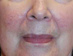 Facial Fillers Before & After Photo