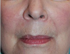 Facial Fillers Before & After Photo