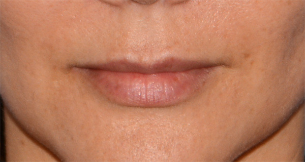 Facial Fillers Before & After Photo