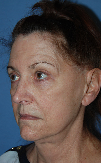 Facial Fillers Before & After Photo