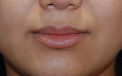 Facial Fillers Before & After Photo