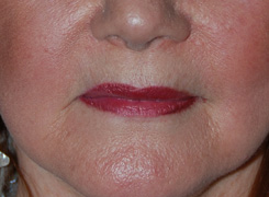 Facial Fillers Before & After Photo