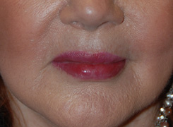 Facial Fillers Before & After Photo