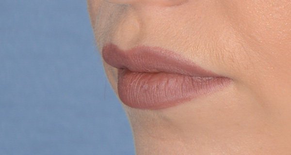 Facial Fillers Before & After Photo