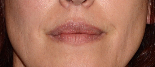 Facial Fillers Before & After Photo