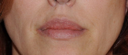 Facial Fillers Before & After Photo