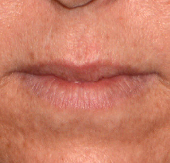 Facial Fillers Before & After Photo