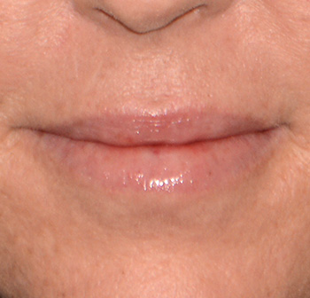 Facial Fillers Before & After Photo