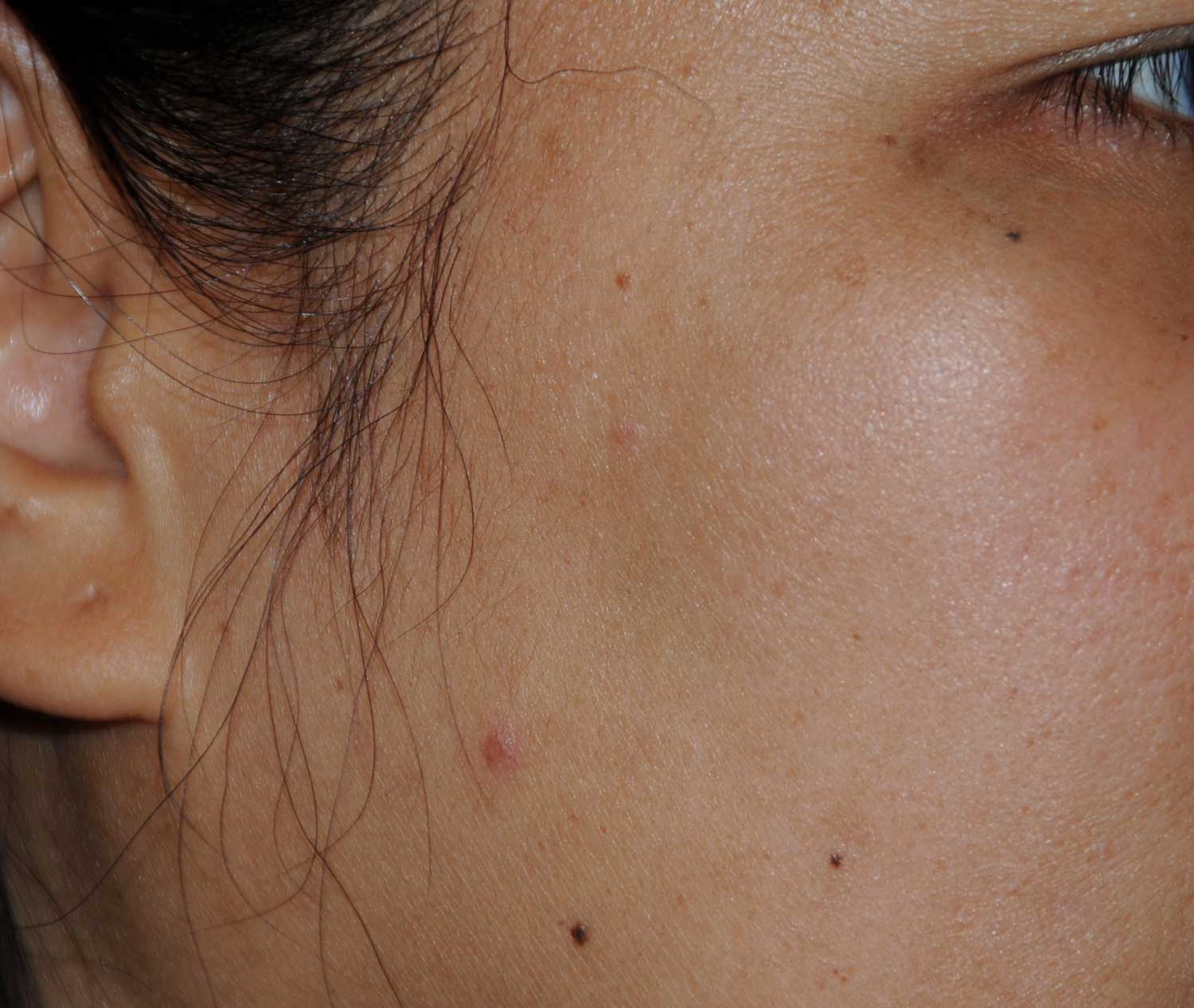 Laser Resurfacing Before & After Photo