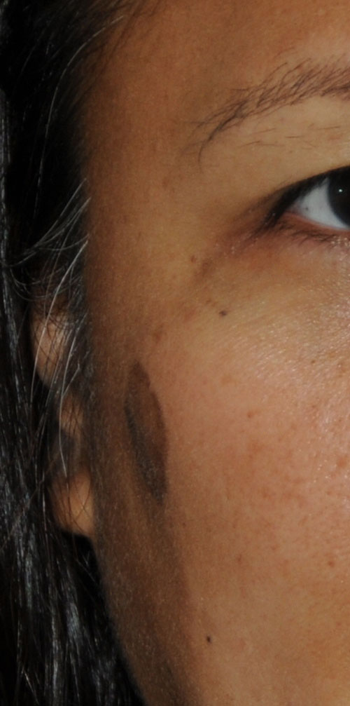 Laser Resurfacing Before & After Photo