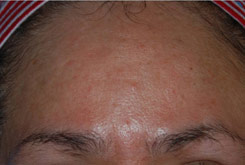 Laser Resurfacing Before & After Photo