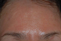 Laser Resurfacing Before & After Photo