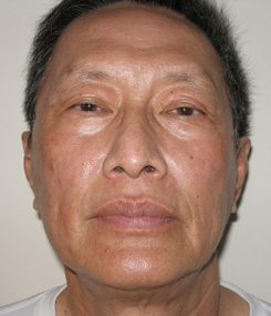 Laser Resurfacing Before & After Photo