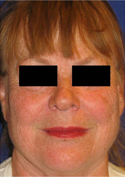 Laser Resurfacing Before & After Photo