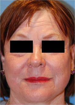 Laser Resurfacing Before & After Photo