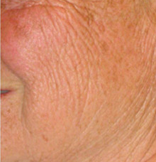 Laser Resurfacing Before & After Photo