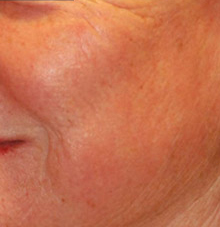 Laser Resurfacing Before & After Photo