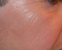 Laser Resurfacing Before & After Photo