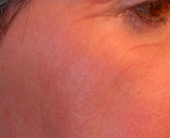 Laser Resurfacing Before & After Photo