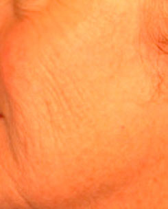 Laser Resurfacing Before & After Photo