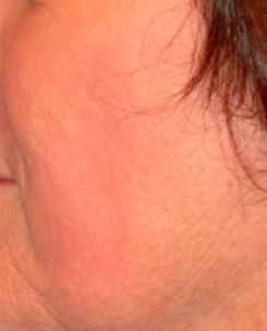 Laser Resurfacing Before & After Photo