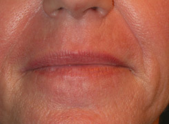 Laser Resurfacing Before & After Photo