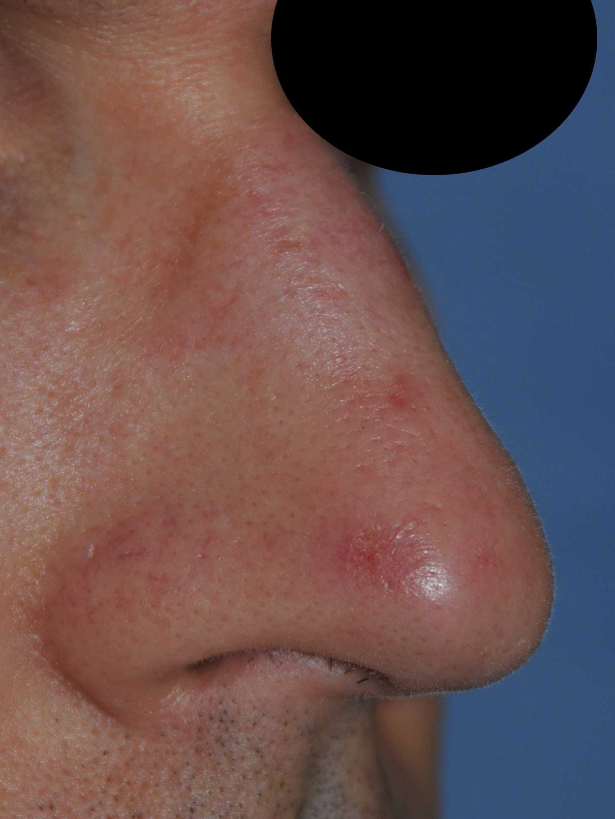 Laser Resurfacing Before & After Photo