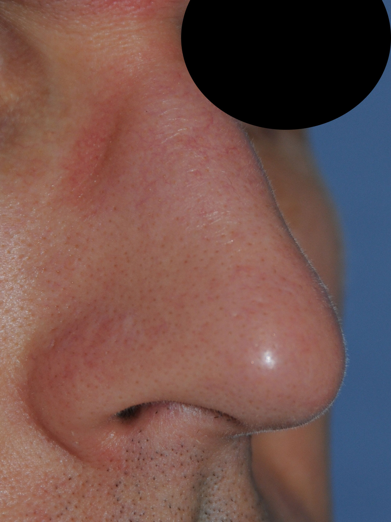 Laser Resurfacing Before & After Photo