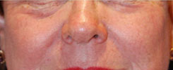 Laser Resurfacing Before & After Photo