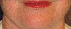 Laser Resurfacing Before & After Photo